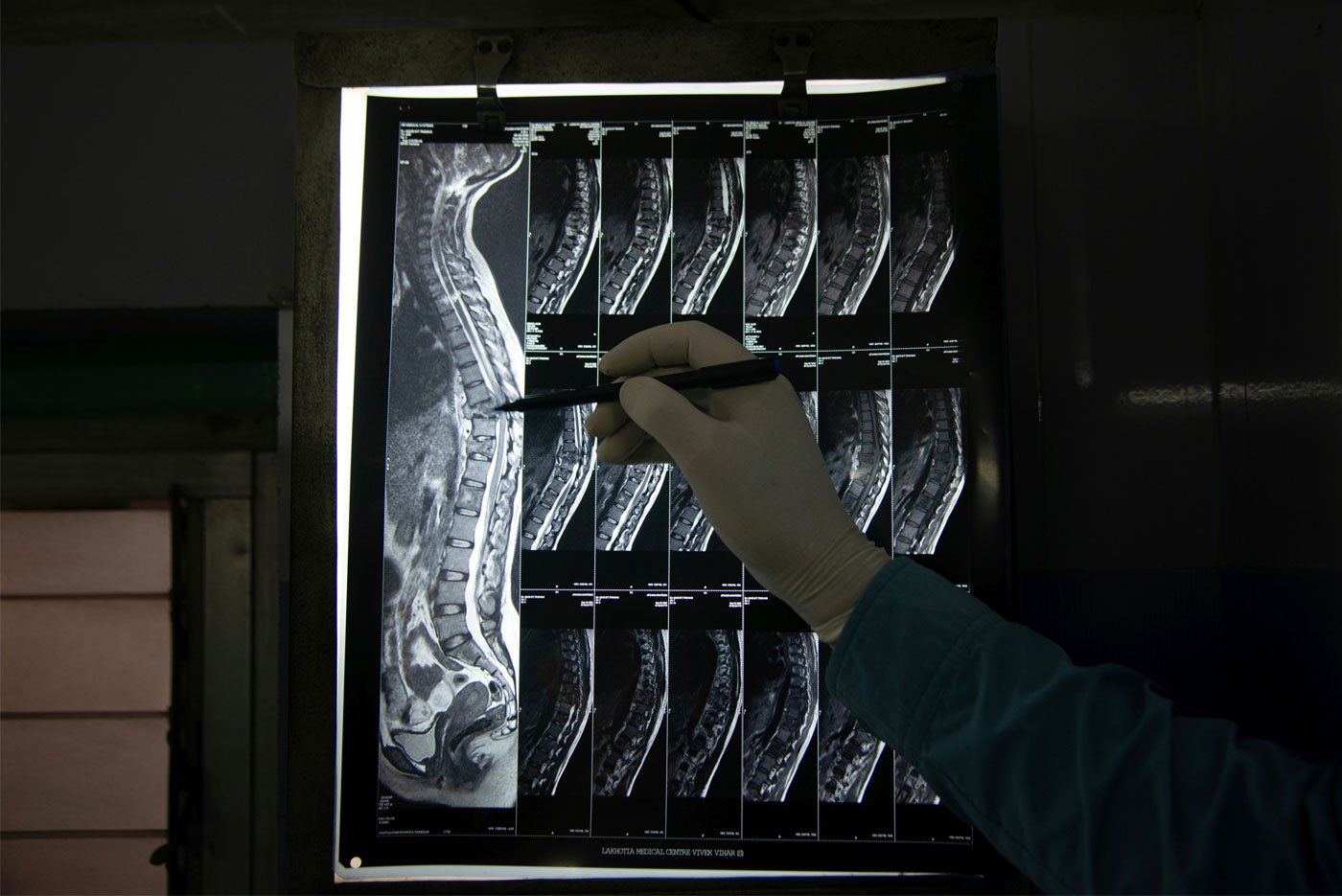 An MRI scan (right) of a 24-year-old patient shows tuberculosis of the spine (Pott’s disease) presenting as compression fractures