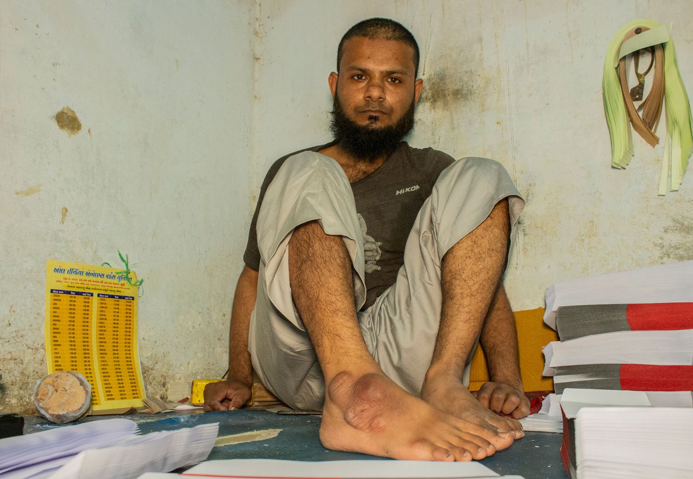 Workers sit in this same position for most of their working hours. Sameeruddin Shaikh (left) showing calluses on his ankle due to continuously sitting with one leg folded under him.