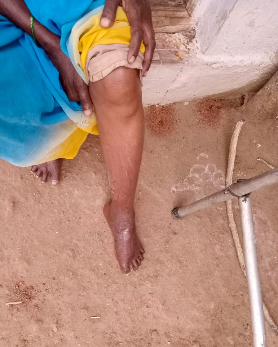 Right: Her wounded foot where the splint pressed down. Mahadevamma can no longer use this foot while walking